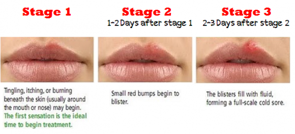 cold-sore-stages - natural remedies