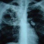 A cheap treatment for pulmonary tuberculosis