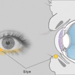 The best treatment for eye stye