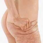 A cheap natural remedy for cellulite