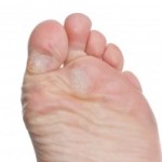 A very simple and useful treatment for calluses