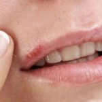 How do you treat herpes naturally?