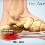 Treat Your Heel Spurs Naturally