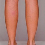 Useful Treatment Tips For Varicose Veins